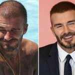 DavidBeckam. greffe de cheveux en Turquie