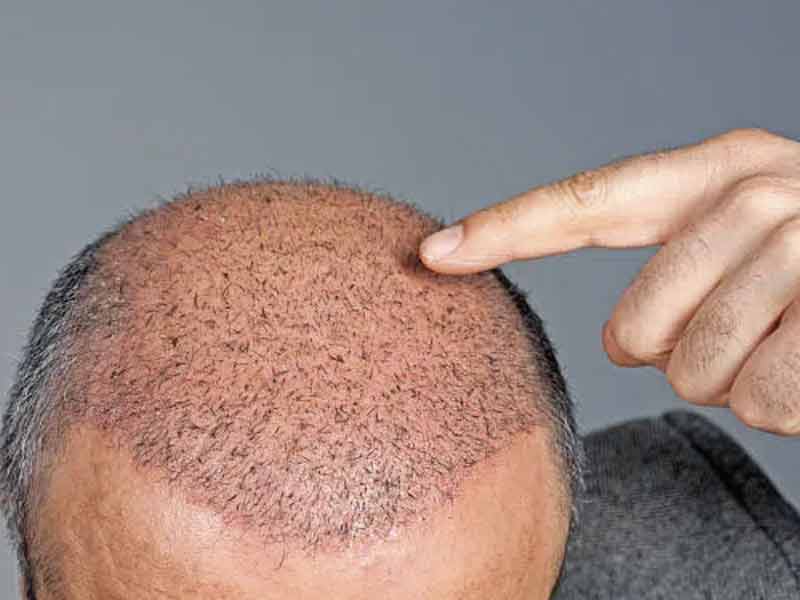 Stratégies d'experts : comment dissimuler une greffe de cheveux après l'intervention