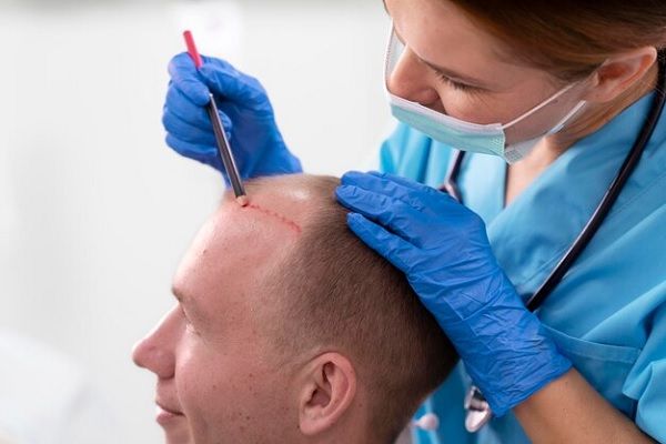 patient souffrant de perte de cheveux en consultation avec un médecin