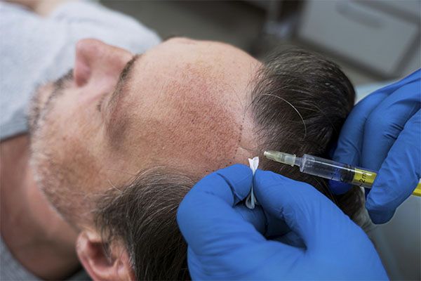 Un homme recevant un traitement de greffe de cheveux avec l'aide d'un spécialiste- greffe de cheveux en Turquie