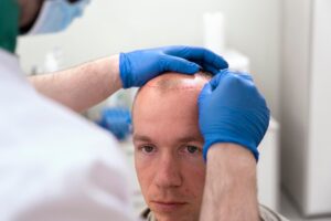 Homme mûr ayant des problèmes de calvitie. Resultat greffe de cheveux