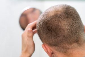 Homme adulte ayant des problèmes de calvitie- greffe de cheveux en Turquie