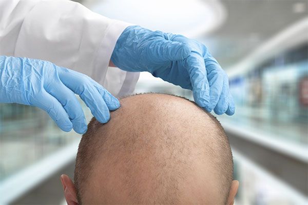 Un médecin examine une personne souffrant d'alopécie. 