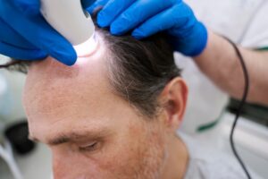 Homme recevant un traitement pour la perte de cheveux. greffe de cheveux en France