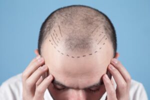 prix des greffes de cheveux