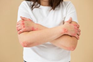 Mains d'un patient souffrant de psoriasis