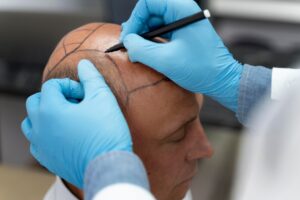 Homme subissant un processus d'extraction d'unités folliculaires.