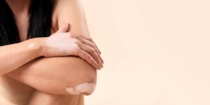 Jeune femme atteinte de vitiligo avec espace de copie. 