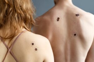 Jeunes atteints de mélanome vue de dos. Quelles sont les verrues les plus courantes