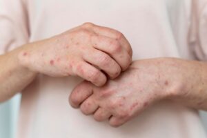 Allergie cutanée sur le bras d'une personne.  scarlatine