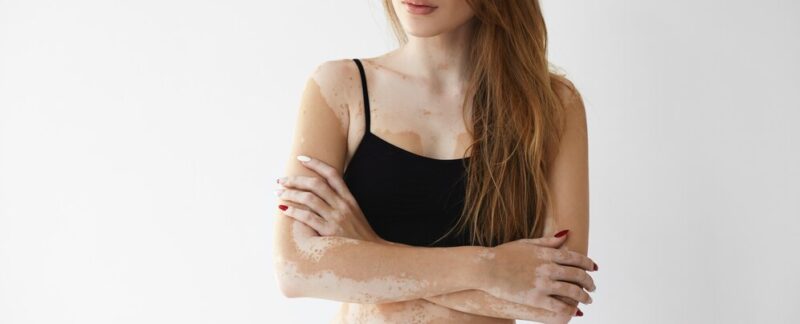 Femme expressive posant à l'intérieur. Qu'est-ce que le vitiligo