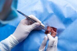 Médecin opérant avec un scalpel métallique