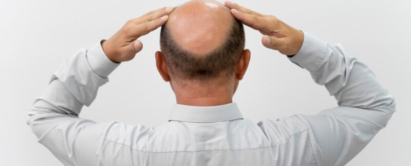 Homme audacieux ayant besoin d'une extraction d'unité folliculaire. Avantages de la greffe de cheveux