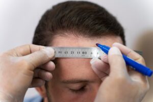 Homme adulte subissant une extraction d'unité folliculaire. 
