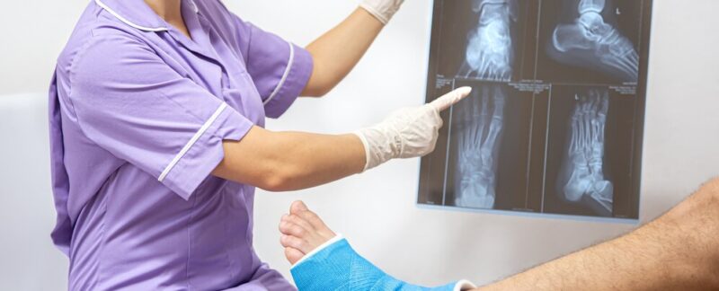 Fracture osseuse du pied et de la jambe sur un patient de sexe masculin examiné par une femme médecin. Greffe de moelle osseuse