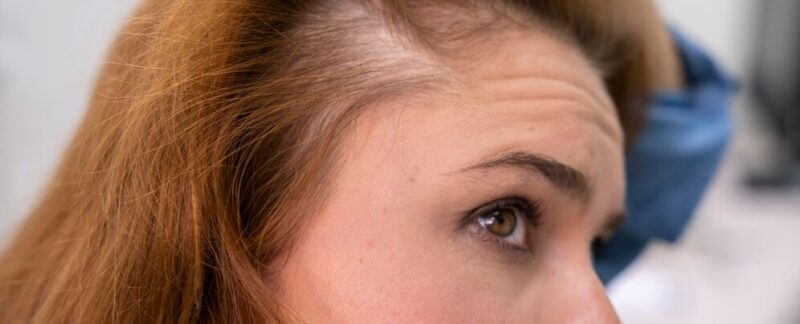 Femme recevant un traitement pour la perte de cheveux dans une clinique.. La trichotillomanie