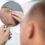 Homme adulte ayant des problèmes de calvitie. Les pellicules dans les cheveux affectent-elles la greffe de cheveux