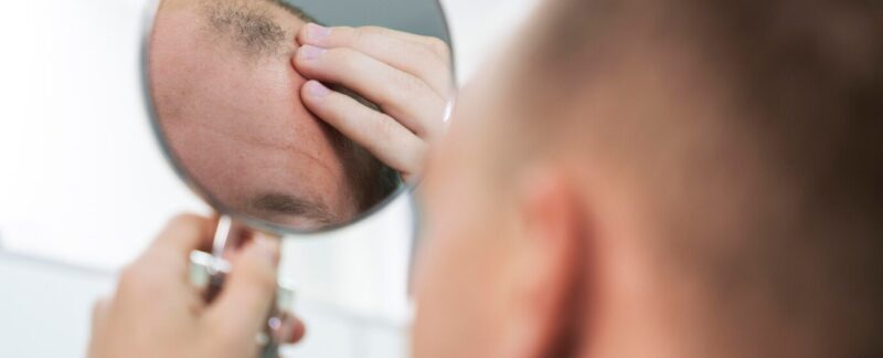 Homme adulte ayant des problèmes de calvitie. Les pellicules dans les cheveux affectent-elles la greffe de cheveux