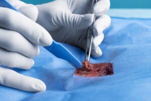Médecin opérant avec un scalpel en métal. Tumeurs bénignes ou non cancéreuses