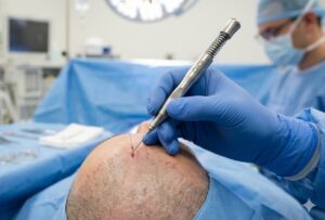 Gros plan sur l'outil DHI utilisé pour l'implantation directe de follicules pileux.