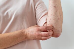 Allergie cutanée sur le bras d'une personne. Varicelle et rougeole