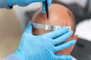 Homme subissant un processus d'extraction d'unités folliculaires. meilleure clinique greffe de cheveux à Paris- greffe de cheveux en France