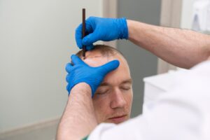 Homme mûr ayant des problèmes de calvitie. meilleur endroit pour une greffe de cheveux à Paris, en France. greffe de cheveux en Turquie