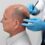 Homme d'âge mûr subissant une extraction d'unité folliculaire. prix des greffes de cheveux.
