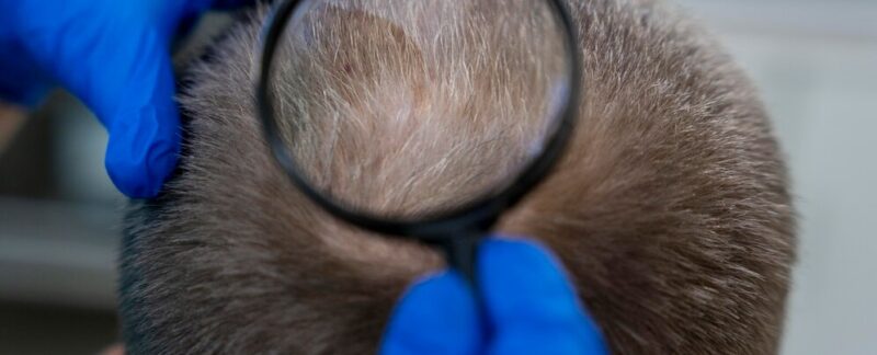 L'explosion des demandes de greffes de cheveux en 2026 : le phénomène qui bouscule la chirurgie capillaire