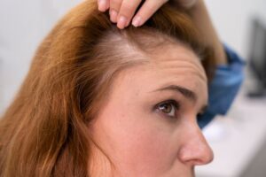 Femme recevant un traitement contre la perte de cheveux dans une clinique. Boutons sur le cuir chevelu après une greffe de cheveux- resultat greffe de cheveux