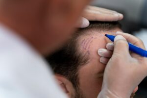 Homme adulte subissant une extraction d'unité folliculaire. Greffe de cheveux FUE en Turquie