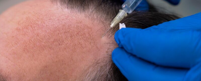 Homme recevant un traitement pour la perte de cheveux. inflammation après la greffe de cheveux
