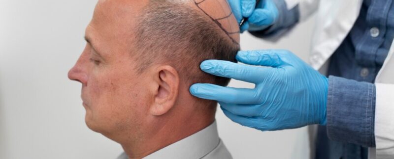 Homme mûr subissant un processus d'extraction d'unités folliculaires. greffe de cheveux