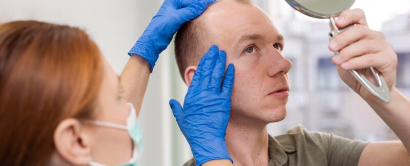 Homme adulte ayant des problèmes de calvitie. Types de greffes de cheveux