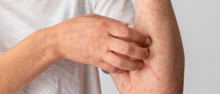 Réaction allergique cutanée sur le bras d'une personne. Varicelle