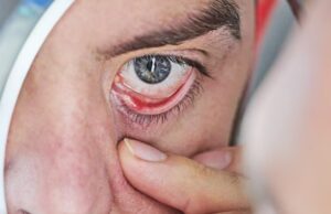Yeux rouges causes courantes et quand consulter un médecin