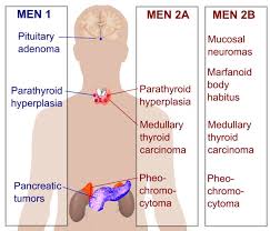 Les principaux types de syndromes NEM