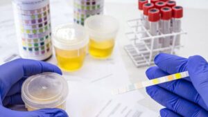 Qu'est-ce que la bacteriurie asymptomatique et comment la détecter