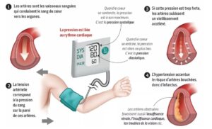 Qu'est-ce que la prehypertension arterielle et quels sont ses risques