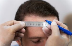 Combien d'UF faut-il prévoir par zone à couvrir lors d'une greffe de cheveux ?