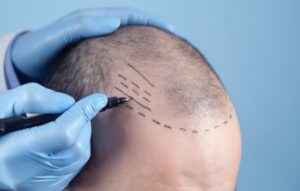 L'importance du diagnostic de la greffe de cheveux nombre de uf par zone à couvrir