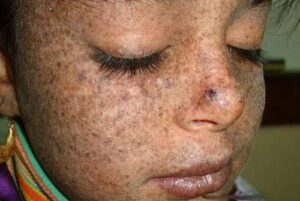 Comment reconnaître et gérer le xeroderma pigmentosum