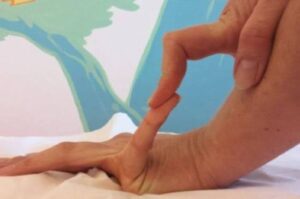 Évidence et statistiques sur le syndrome d'Ehlers-Danlos vasculaire