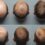 Greffe de cheveux evolution mois par mois : à quoi s'attendre