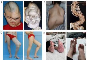 Informations techniques essentielles sur le syndrome de Proteus