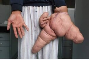 Le syndrome de Proteus en chiffres et données scientifiques