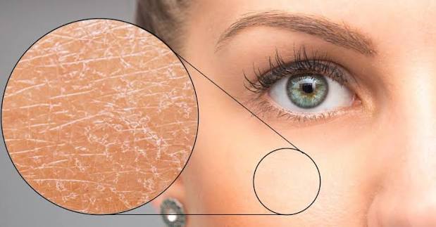 Xeroderma pigmentosum : symptômes, causes et prise en charge