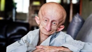 Évidence scientifique et statistiques sur le syndrome de Werner