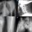Fibrodysplasie ossifiante progressive