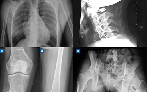 Fibrodysplasie ossifiante progressive